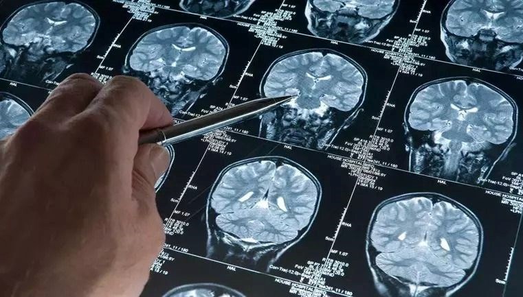 Bilim Camiasını Sarsan Gelişme: En Genç Alzheimer Vakası Belirlendi!