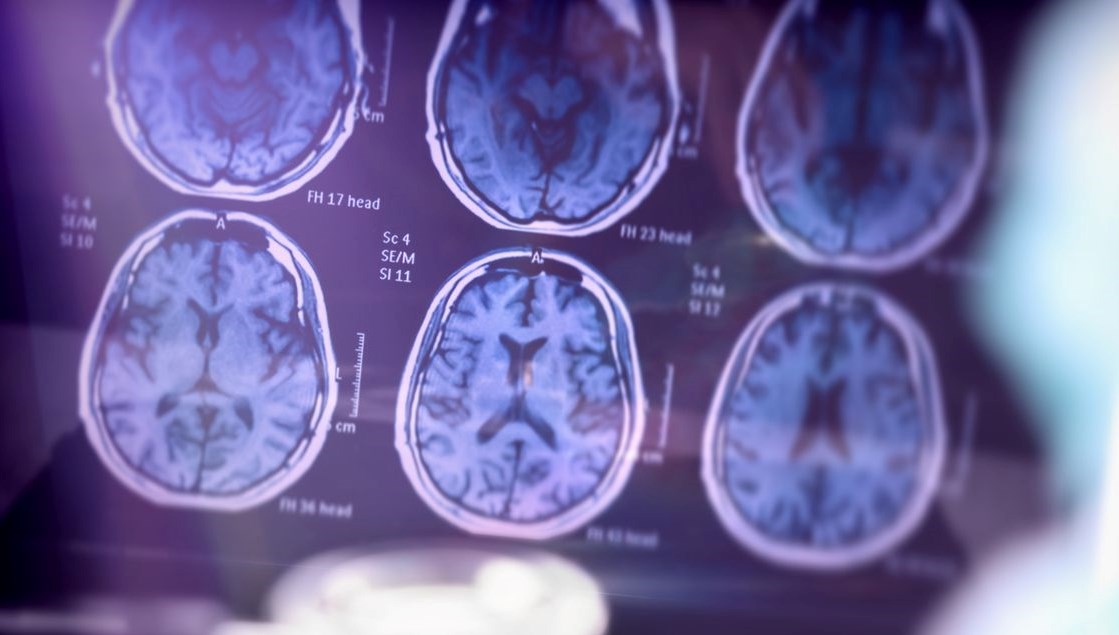 Alzheimer'da Umut Işığını Görüyoruz: Ölümcül Hastalıkla Mücadelede Yeni Gelişmeler