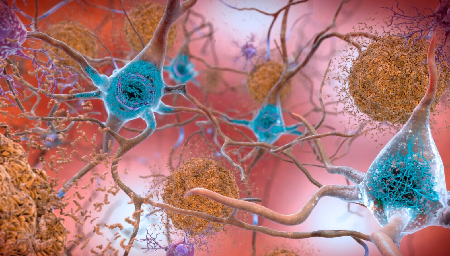 Alzheimer Tedavisinde Çığır Açan Gelişme: İki Kanser İlaçları Umut Vaat Ediyor!
