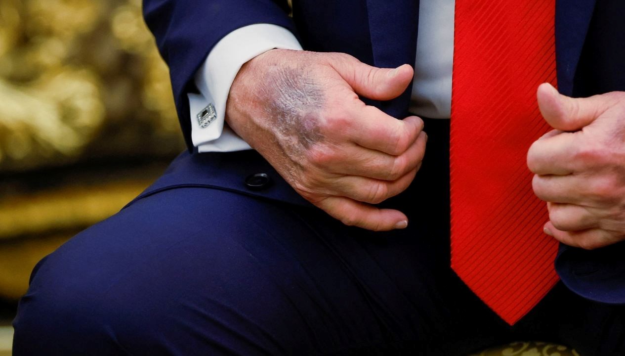 Trump'ın Eli Yine Tartışma Konusu, Beyaz Saray'dan Yanıt Geldi