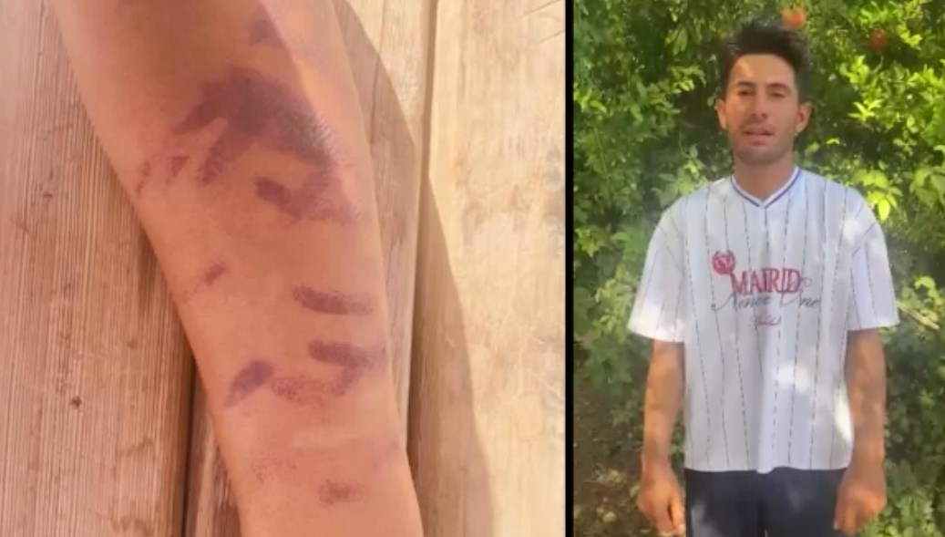 Lazer Epilasyonunda Korku Dolu Anlar: